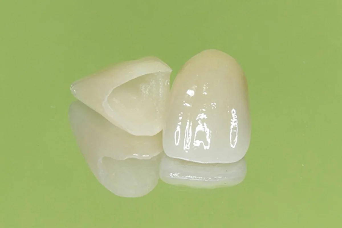 ⑤ 経験豊富な歯科技工士による熟練の技術で、精密な補綴物を製作します