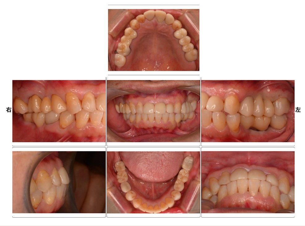 全顎治療後の口腔内写真(上顎・右側方・正面・左側方・下顎・前歯部)